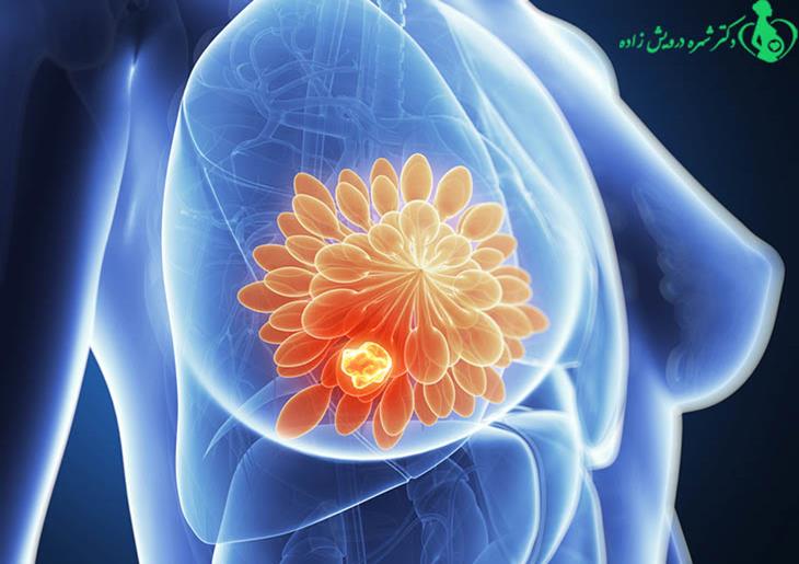 سرطان سینه و هر آنچه که نیاز است بدانید!